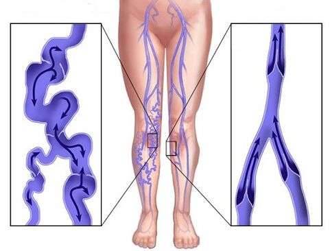 Comparación de venas afectadas por venas y venas varicosas después del uso de Veniselle