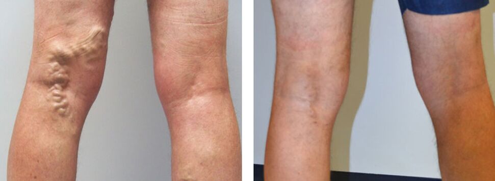 Foto antes y después de usar Veniselle, experimente en el uso de crema