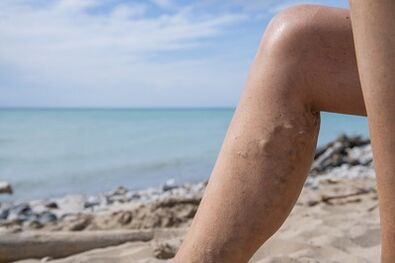 Venas varicosas en las piernas