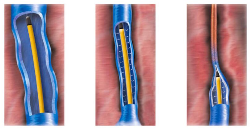 La ablación por radiofrecuencia como método para tratar las venas varicosas.