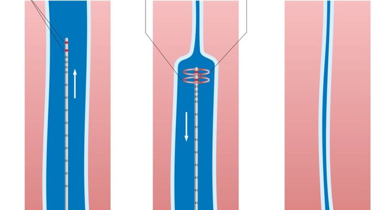 Tratamiento con láser para las venas varicosas en las piernas.