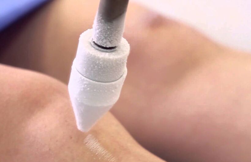 tratamiento de las venas varicosas en las piernas con crioterapia